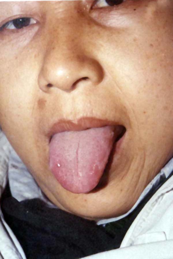 肝胆湿热的舌苔图片