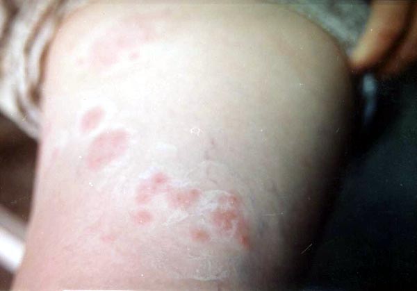 鼠疫皮肤红斑图片图片