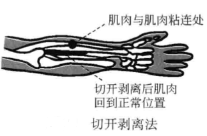 小针刀手法示意图图片