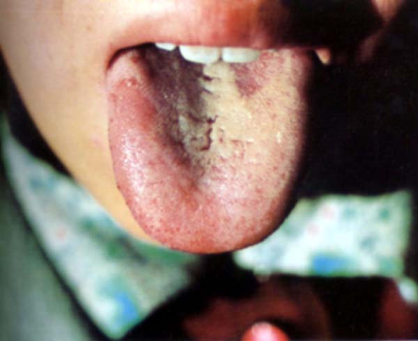 淡红舌类剥苔