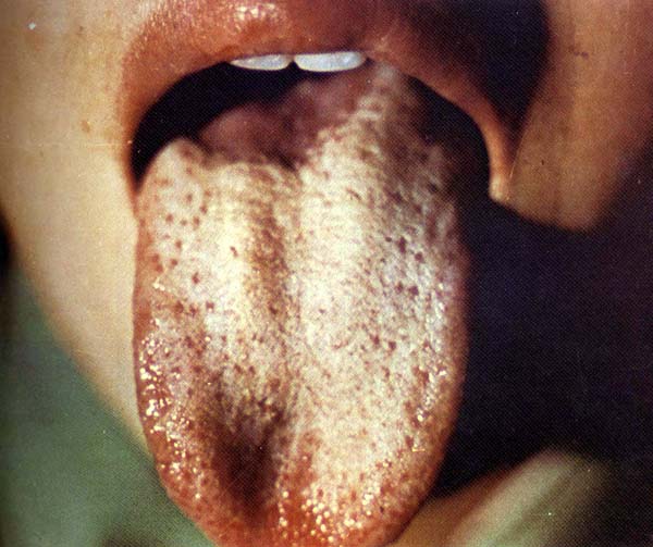 舌头舌苔脱落图片