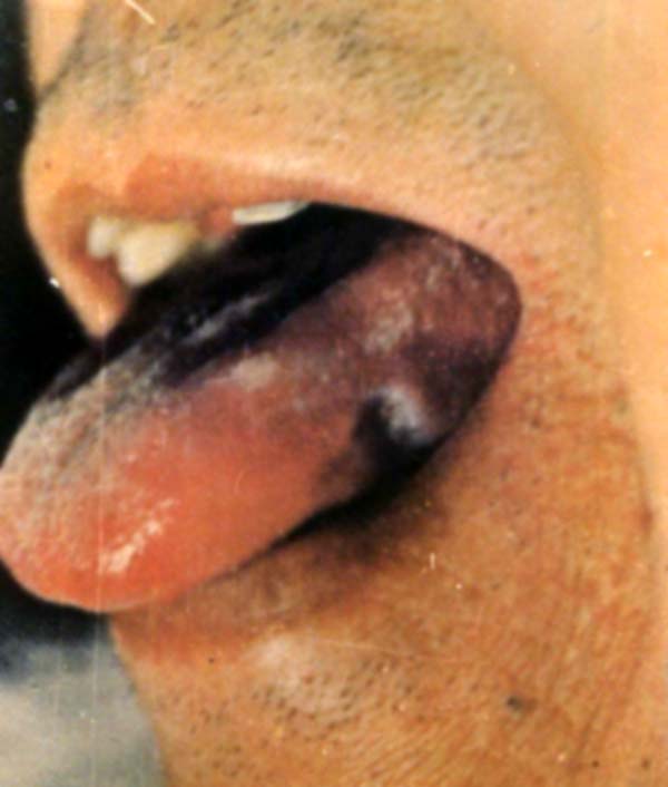 舌疳 绛紫舌
