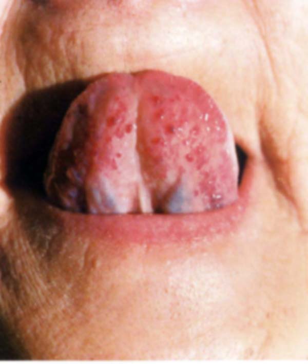 舌下络脉瘀血图片